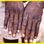 Mpox strain spreads across Europe