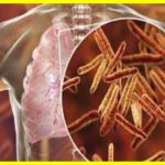 A new drug for tuberculosis