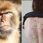 Monkeypox alert near Moscow: Five hospitalized