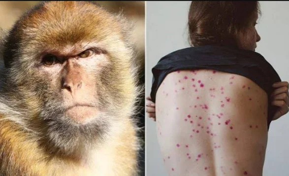 Monkeypox alert near Moscow: Five hospitalized